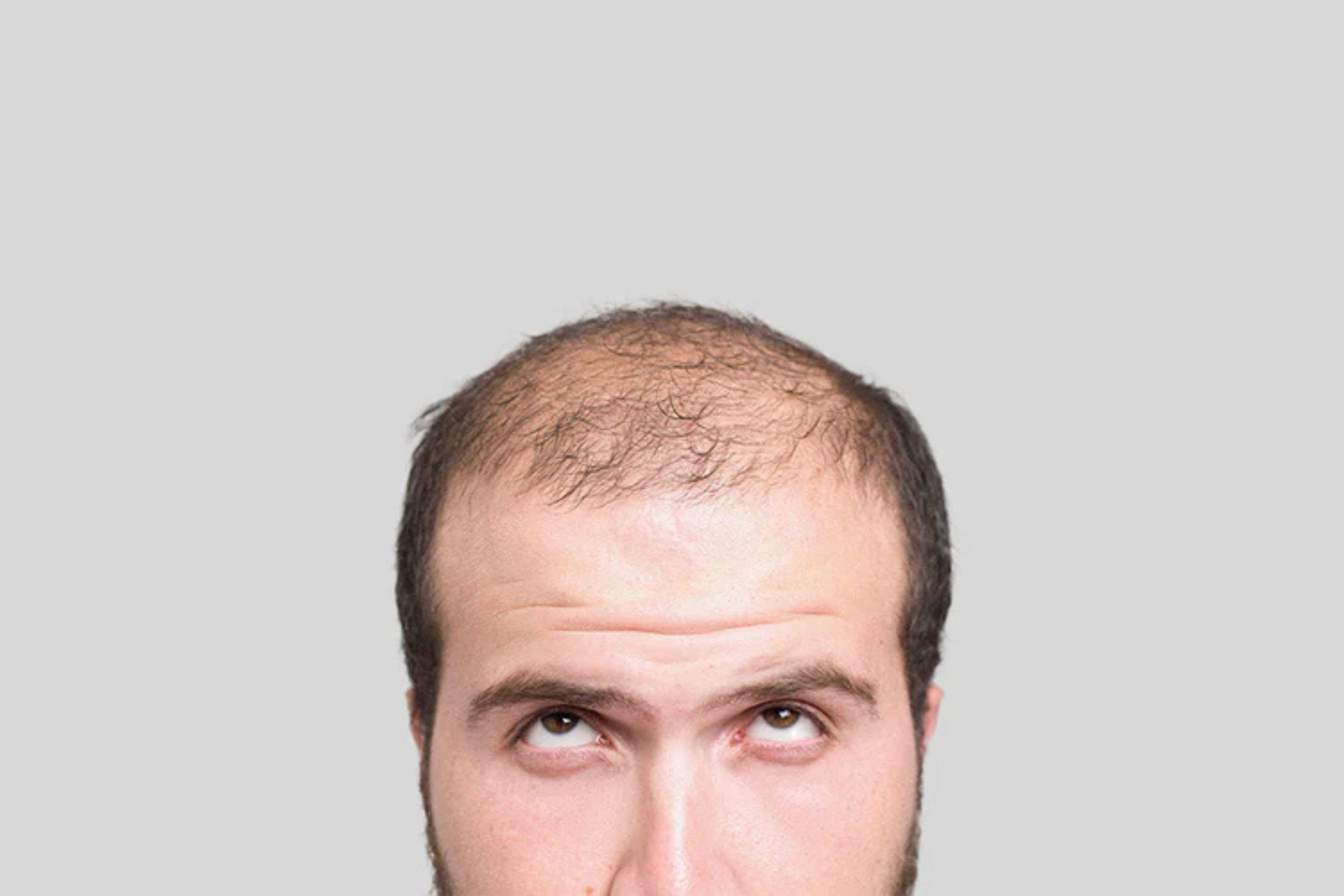 Embracing Change: The Psychological Impact of Hair Restoration