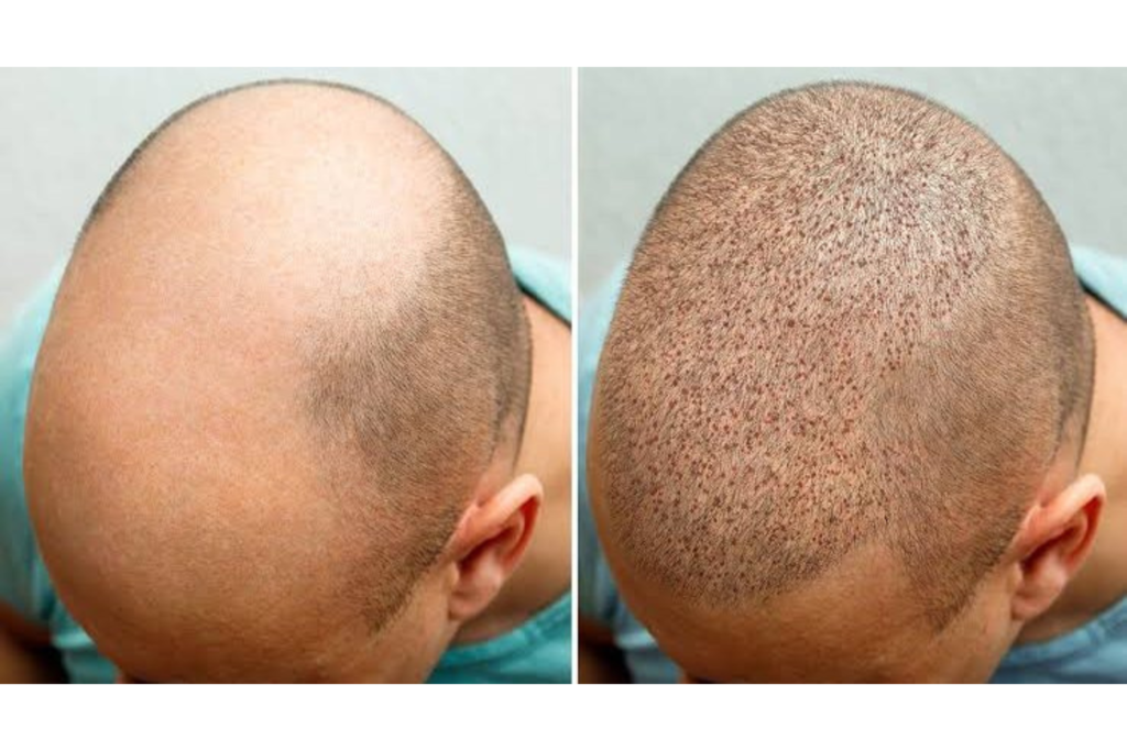 The Science Behind Hair Restoration: Understanding Techniques and Innovations